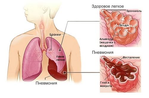 тянущее ощущение под ребром - др… - вопрос № - Терапия